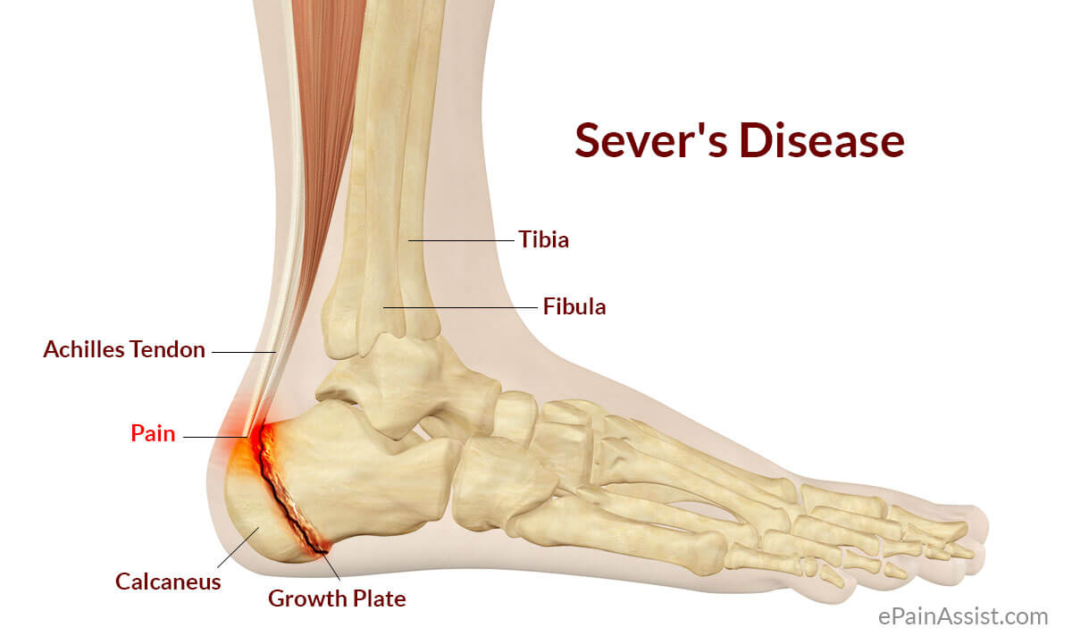 What is Plantar heel pain? Learn everything about it here!