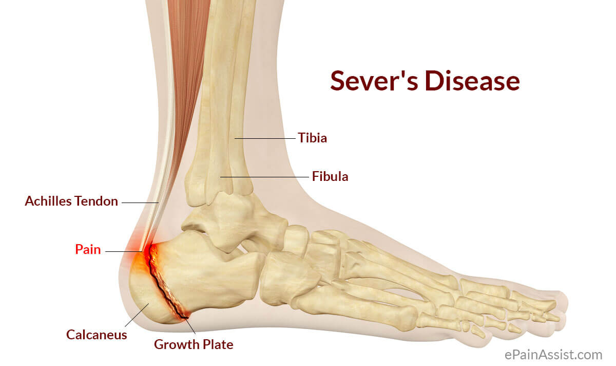 Main Causes of Back of Heel Pain in North Seattle | Foot and Ankle Center  of Lake City